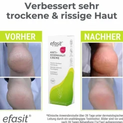Efasit Hornhaut-Anti-Hornhaut Creme, 75 ml