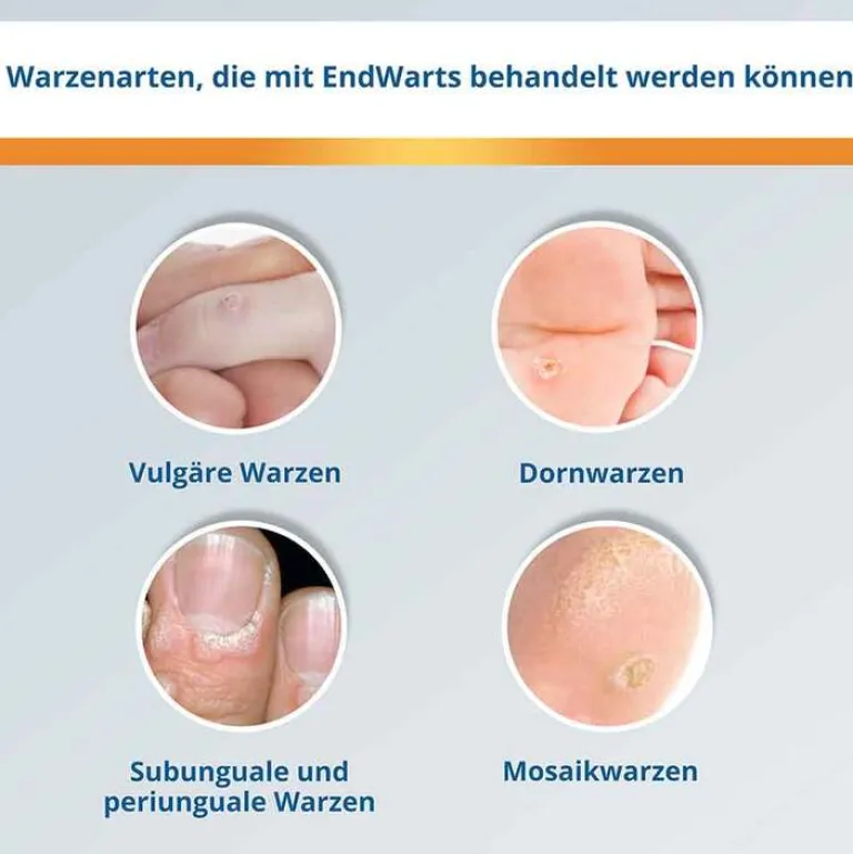 ® CLASSIC Lösung, 3 ml^Endwarts Hot