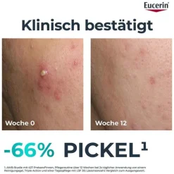 Eucerin Dermopure Clinical Triple Action Creme, 40 ml- Unreine Haut|Hauttypen