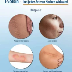 Narbenpflaster 2,5cm x 200cm, 1 St^Evolsin Sale