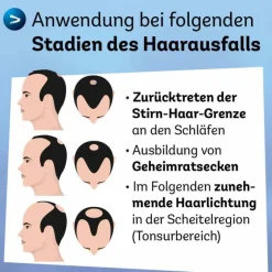 Dexcel Mittel Gegen Haarausfall-Minoxidil 50 mg / ml Spray z.Anw.a.d.Kopfhaut, 60 ml