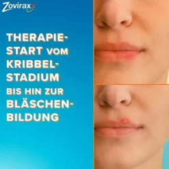 Lippenherpescreme. 5 % Aciclovir, 2 g^Zovirax Online
